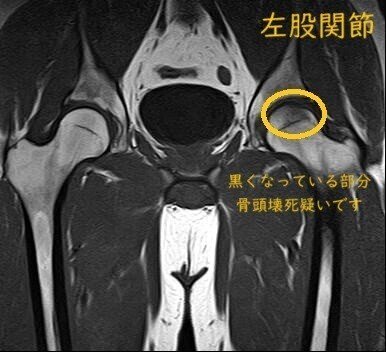 左股関節-1の説明(黒くなっている部分骨頭壊死疑いです)