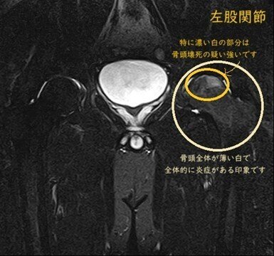 左股関節-2の説明(特に濃い白の部分は骨頭壊死の疑い強いです。骨頭全体が薄い白で全体的に炎症がある印象です。)