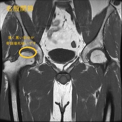 右股関節-1の説明(薄く黒い部分が骨頭壊死疑いです。)