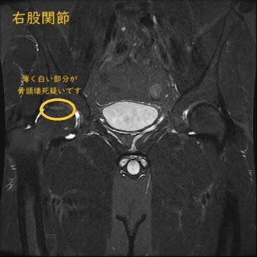 股関節-2の説明(薄く白い部分が骨頭壊死疑いです。)